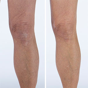 how-to-get-rid-of-crepey-skin-on-your-legs